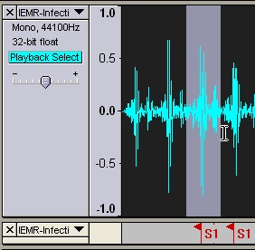 Thinklabs cardiac sounds editing sound